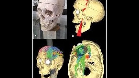 Automatic 3D BRAIN TUMOR Segmentation using Tensorflow | Deeplearning | +91-8283824812 for query