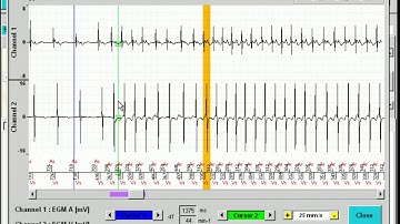 Interrogating a Microport pacemaker | Diagnostics AIDA