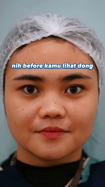 FILLER HIDUNG #youtubeshorts #shortsvideo #youtube #kecantikanwajah #fypシ #fyp