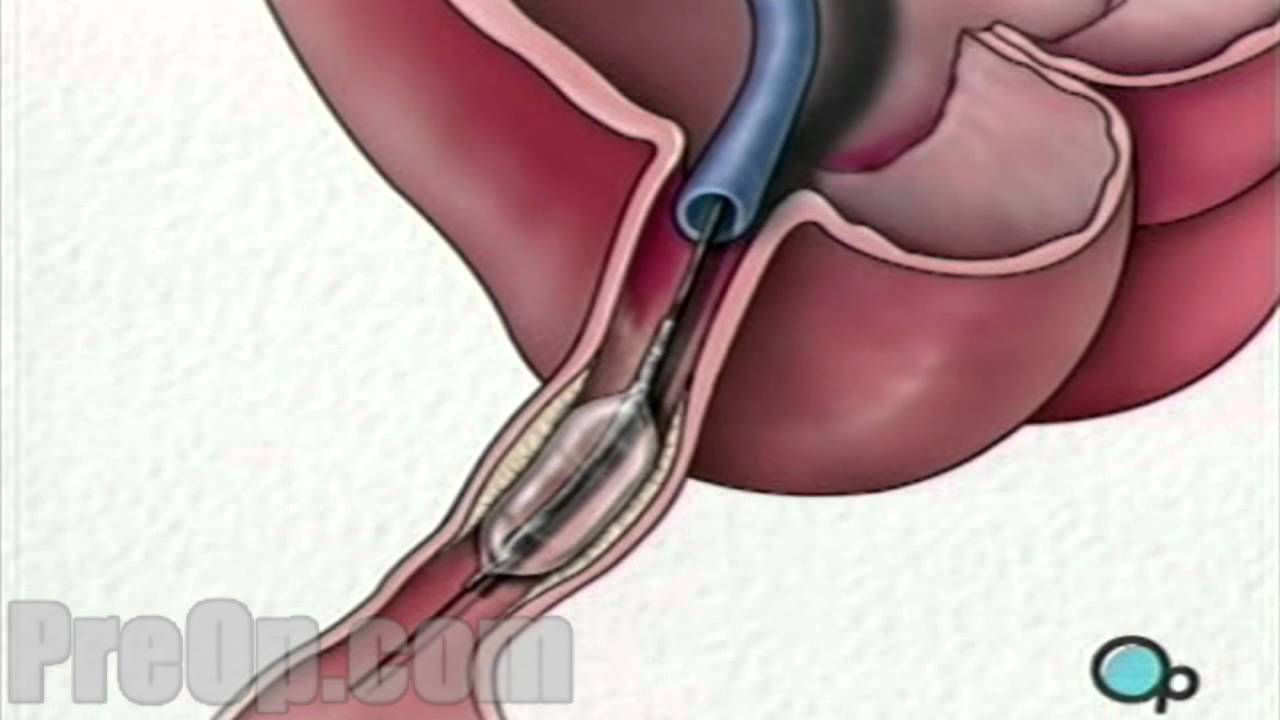 Stent Implantation Coronary Angioplasty - Preop Patient Education Hd