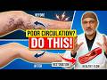Say Goodbye to Varicose Veins! Heal Poor Circulation With This Secret (NO Surgery) | Doctor Explains