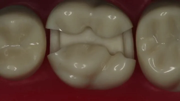 Class II Amalgam Preparation #14 MOD | Amalgam Pre...