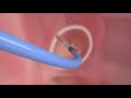 Catheter Ablation Animation