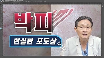 30년 피부 전문의! 피부 박피에 대한 모든것!!