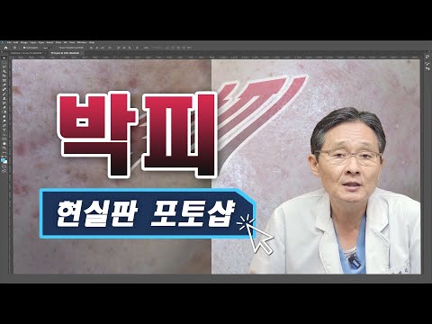 30년 피부 전문의! 피부 박피에 대한 모든것!!