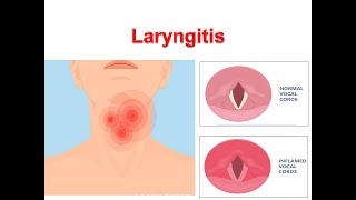 Laryngitis