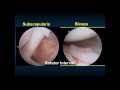 619 PT2 Keys to a Complete Diagnostic Shoulder Exam Normal Diagnostic Shoulder Arthroscopy