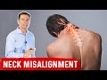 Chronic Neck Misalignment Does Not Come From the Neck