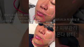 부산 문제성,염증성 피부 잘하는 곳 #부산피부관리 #여드름관리 #문제성피부