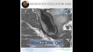 Whats The Dx Osteitis Condensans Ilii Mri