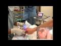 GlideScope Pediatric Airway Rounds Case Study: 2 month old, Inguinal Hernia Repair