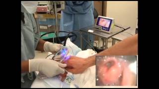 GlideScope Pediatric Airway Rounds Case Study: 2 month old, Inguinal Hernia Repair