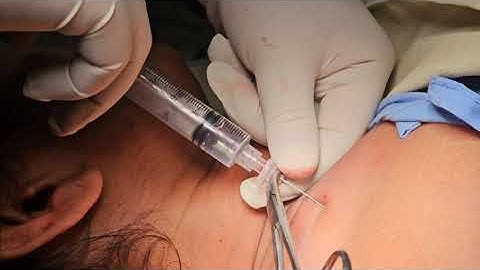 SupraClavicular Approach Of Brachial Plexus block - A LANDMARK TECHNIQUE