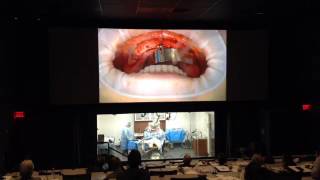 Rehabilitation of a Full Arch Utilizing All-on-4™ Treatment Concept, Part 2