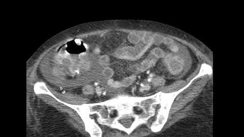 73yo C Diff CT Abd.mp4
