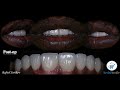 Layered Emax Veneers