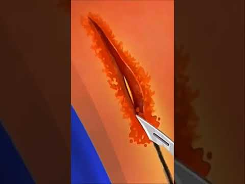 عملية إستئصال الزائدة الدودية Appendectomy