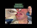 Lip Fordyce Spots Removal With CO2 Laser 