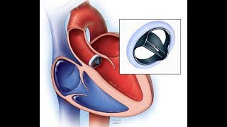 Aortic Valve Replacement - 3 weeks post op recovery update