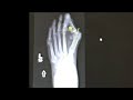 Step into comfort: Breakthrough bunion procedure