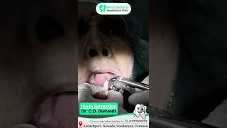 🦷 Tooth Extraction: