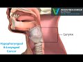 Hypopharyngeal &amp; Laryngeal Cancer (throat) - What Is It? Symptoms &amp; Treatment? Head &amp; Neck Cancer
