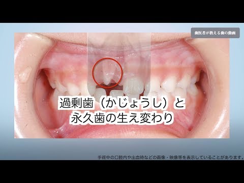 過剰歯（かじょうし）と 永久歯の生え変わり