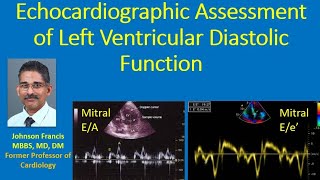 Echocardiographic Assessment of Left Ventricular Diastolic Function