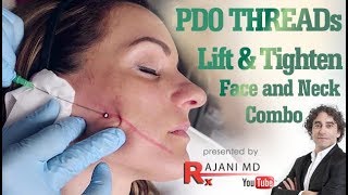 PDO Thread Lift to Tighten Face and Neck