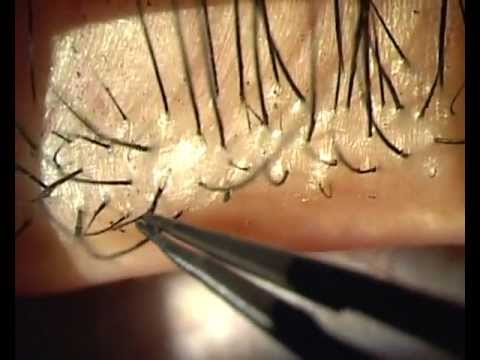 Human Demodex Mite: The Versatile Mite of Dermatological ...