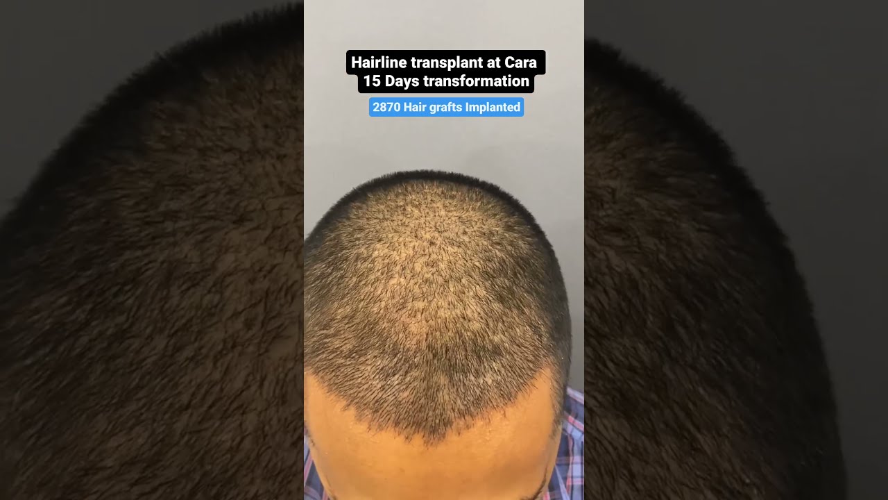 15 DAY TRANSFORMATION See His Hair Before And After Sapphire FUE Transplant