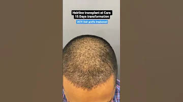 15 DAY TRANSFORMATION See His Hair Before And After Sapphire FUE Hair Transplant 