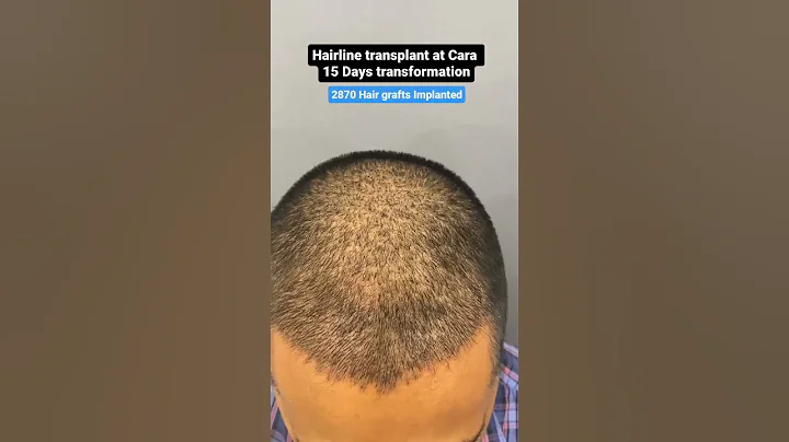 15 DAY TRANSFORMATION: See His Hair Before and After Sapphire FUE Hair Transplant