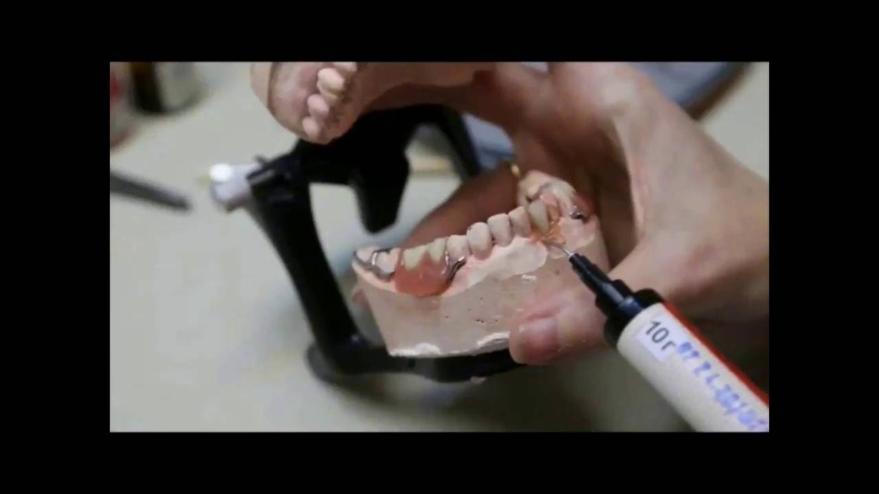 Изготовление бюгельного протеза из фотополимерного материала НОЛАТЕК ...