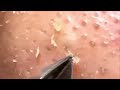 blackhead removal from nose/ old aged blackheads removal