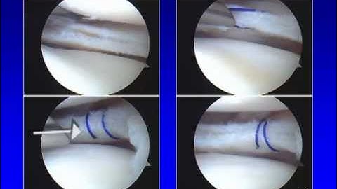 Torn Meniscus Cartilage Overview