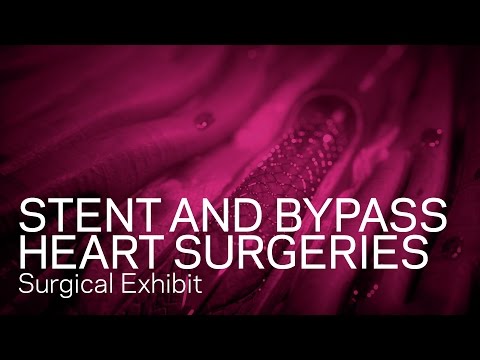 Stent Procedure and Cardiac Bypass Surgery Animation