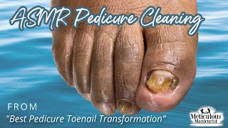 ?ASMR Pedicure Cleaning?‍♀️Best Pedicure Toenail Transformation?