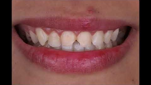 Direct composite restorations of two centrals using fantastic 4