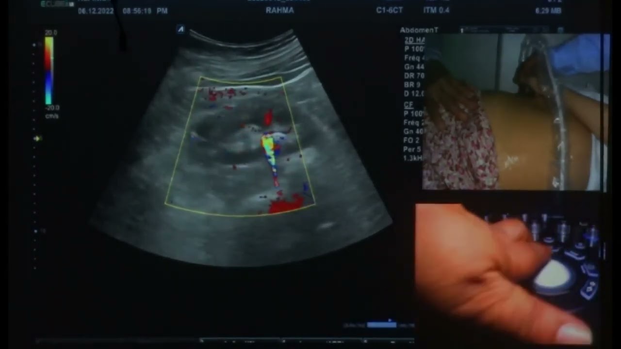 Formation : lithiase rénale /échographie renale / effet de scintillement