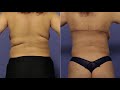 Bra Line Back Lift | Stoker Plastic Surgery