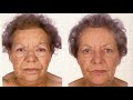 Dieta cetogenica para hipotiroidismo. Dieta keto con hipotiroidismo. Hipotiroidismo dieta.