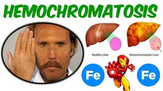 Hemochromatosis- Iron Overload Disorder!