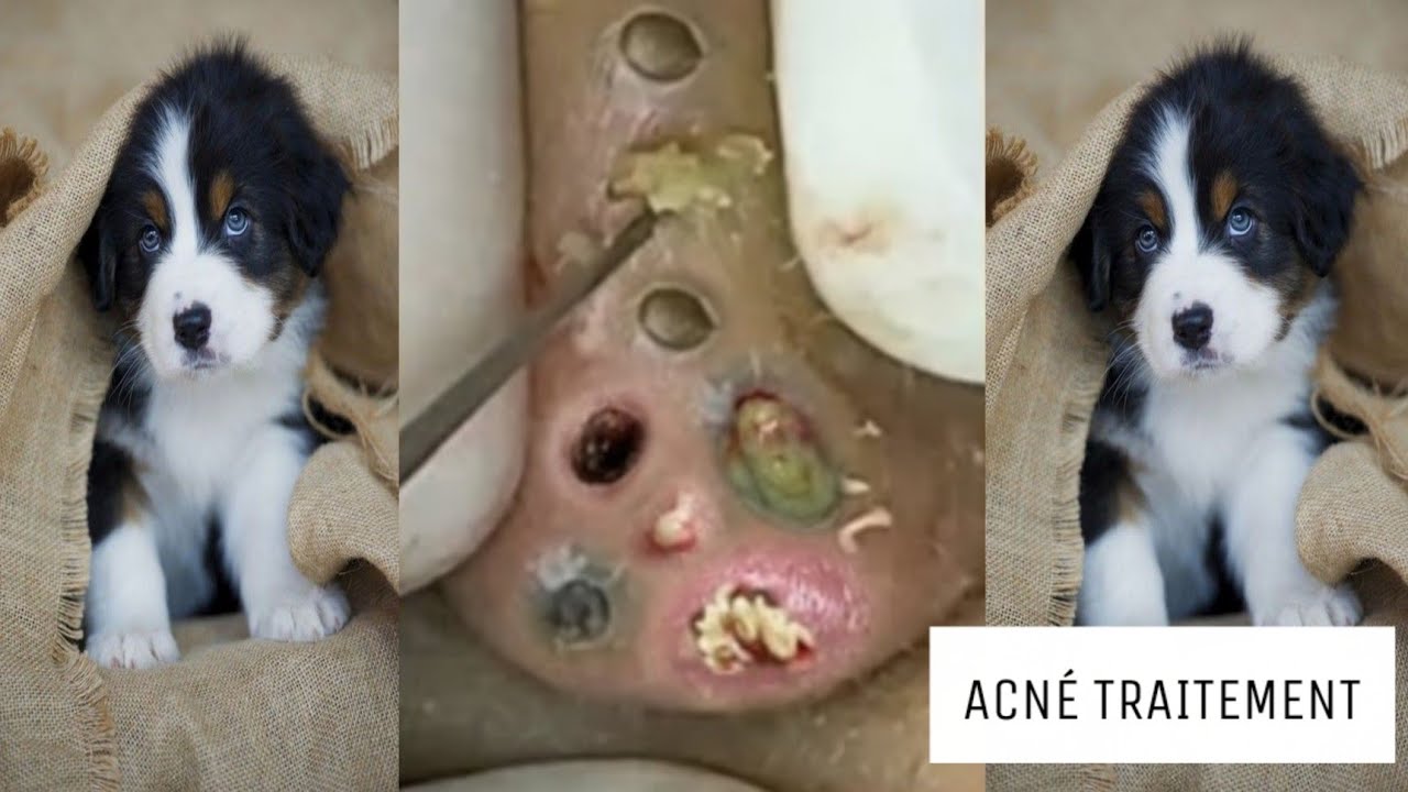 Extraction point noir, acné, kyste en profondeur #21 - YouTube