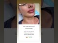 Lips Enhancement / Contouring - Get Dreamy Lips | EDEN AESTHETICS Dubai