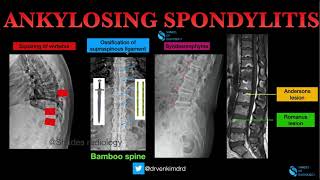 Ankylosing Spondylitis- Classic Imaging features Syndesmophyte Or Osteophyte