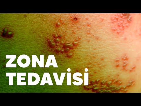 Zona Tedavisi Nedir ? || Fizyorad