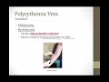 Myeloproliferative disorders || Boards and Beyond || USMLE step 1