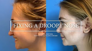 Dr William Portuese   Rhinoplasty Dynamic Droopy Nose