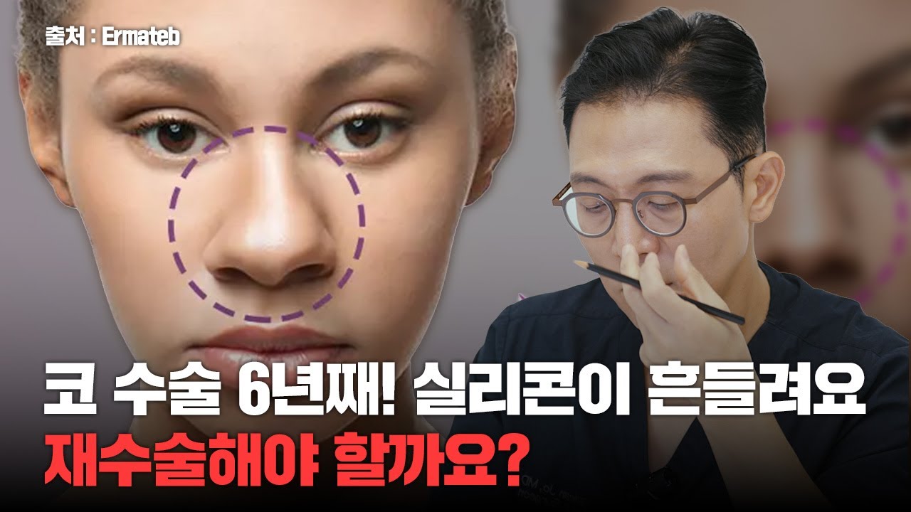 328화. 코수술 6년째! 실리콘이 흔들려요 재수술해야 할까요?